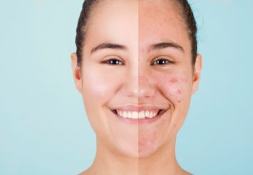 earthed plasma for acne